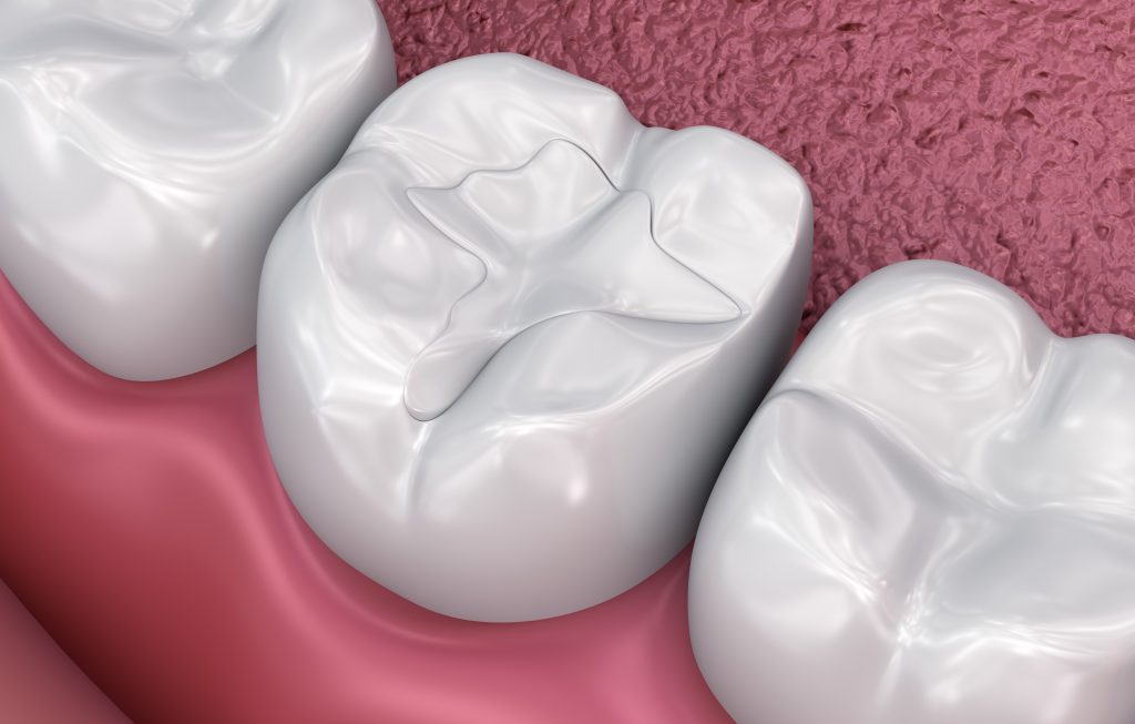 What Are The Benefits Of Composite Fillings?