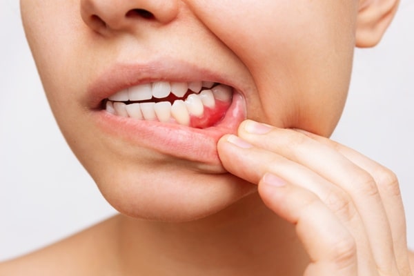 Periodontal Disease Treatment at Casa Dental